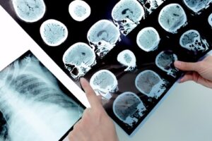 How to Prove Negligence in Ohio Brain Injury Cases