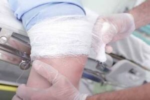Navigating Workers’ Compensation for Amputation Injuries in Ohio