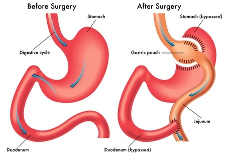 Pros and Cons of Gastric Bypass Surgery